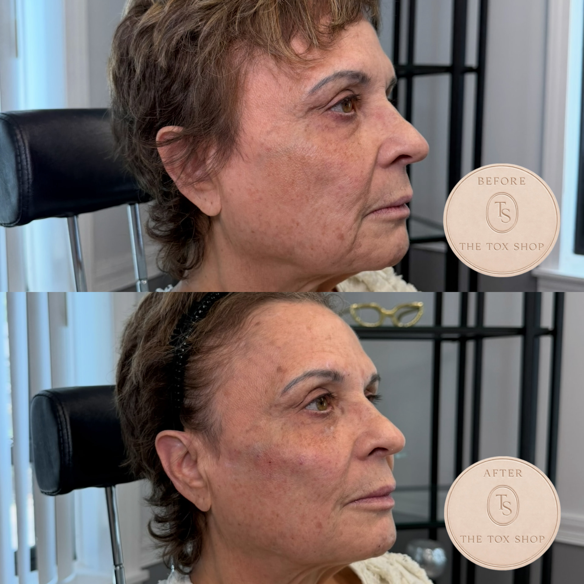 The Tox Shop facial rejuvenation before and after result