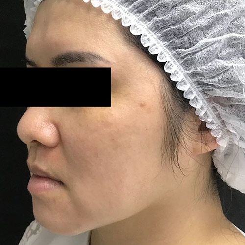 Hyperpigmentation result — after