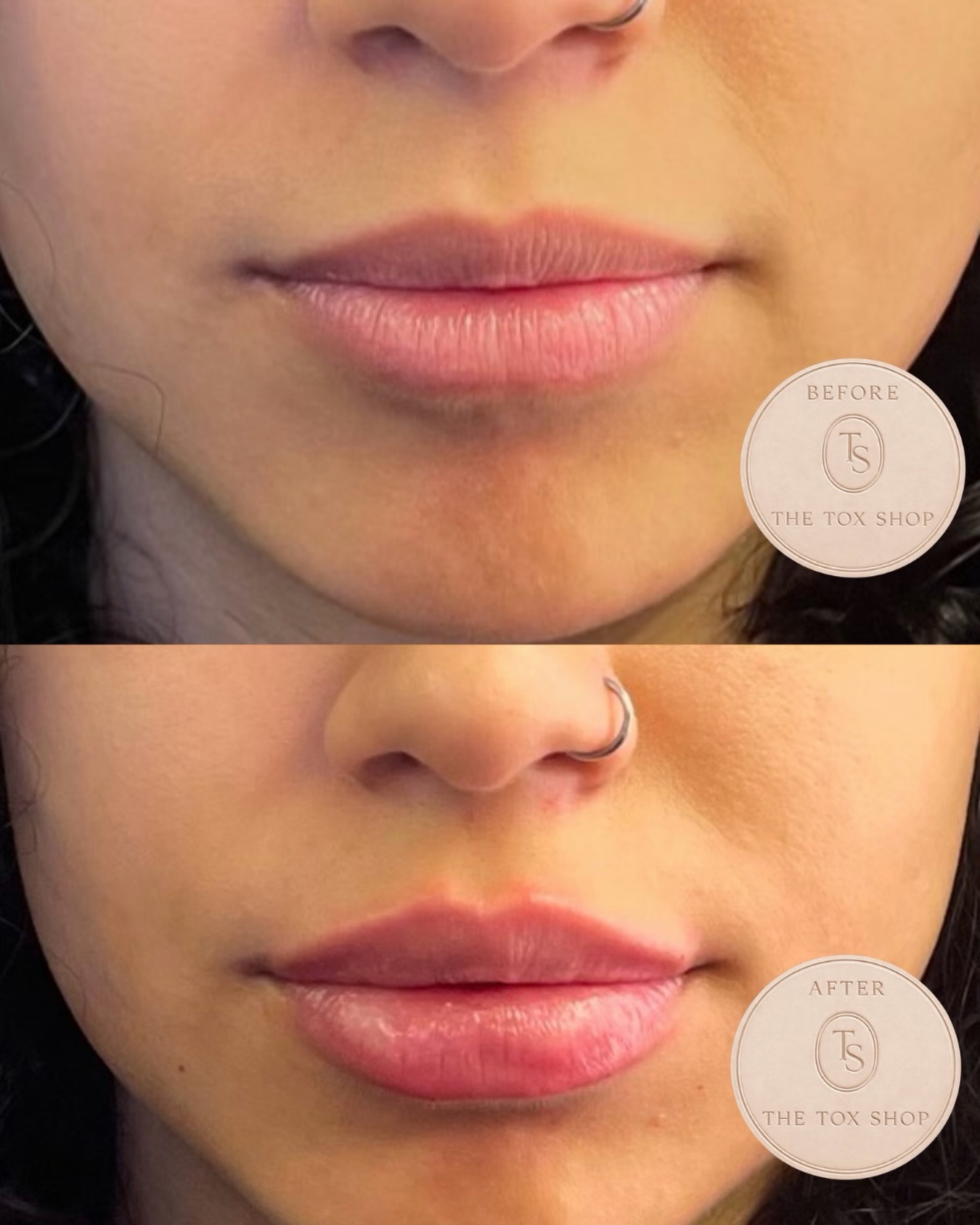 The Tox Shop lip filler transformation before and after