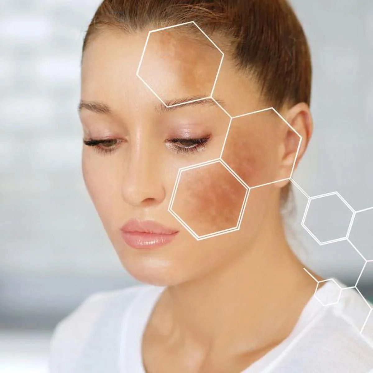 Hyperpigmentation