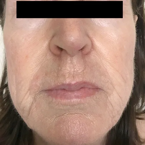 Wrinkles and lip lines result — after