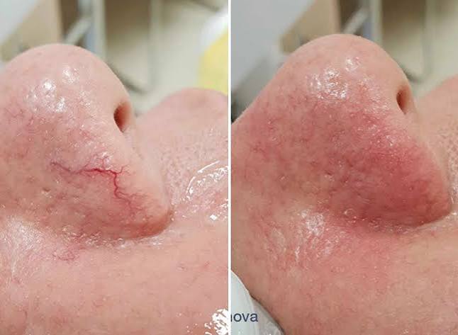 Spider Vein Removal