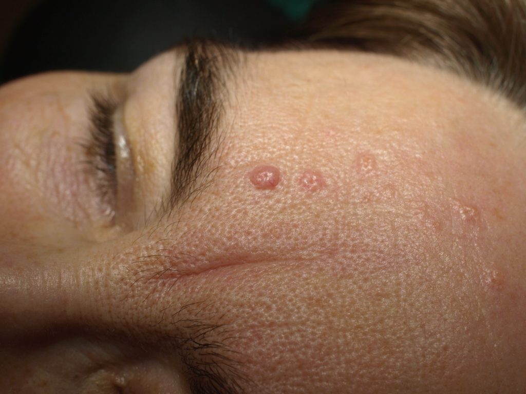 Sebaceous Hyperplasia