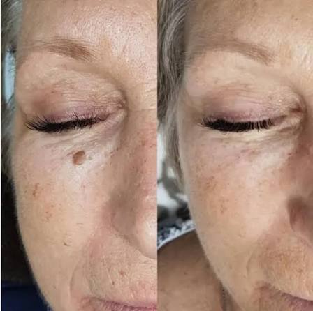 Skin Classic before and after — mole and pigmentation removal