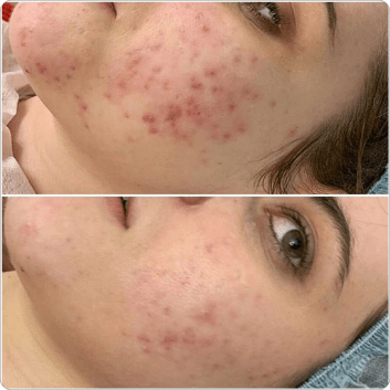BioRePeel before and after result 2