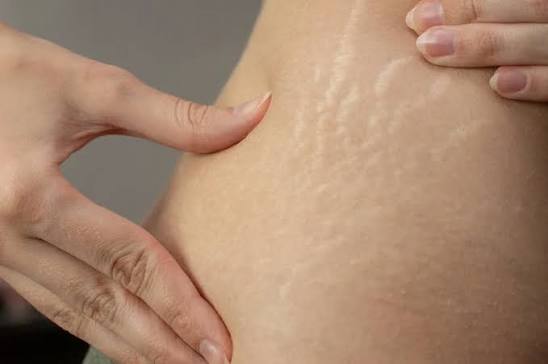 Stretch Mark Removal