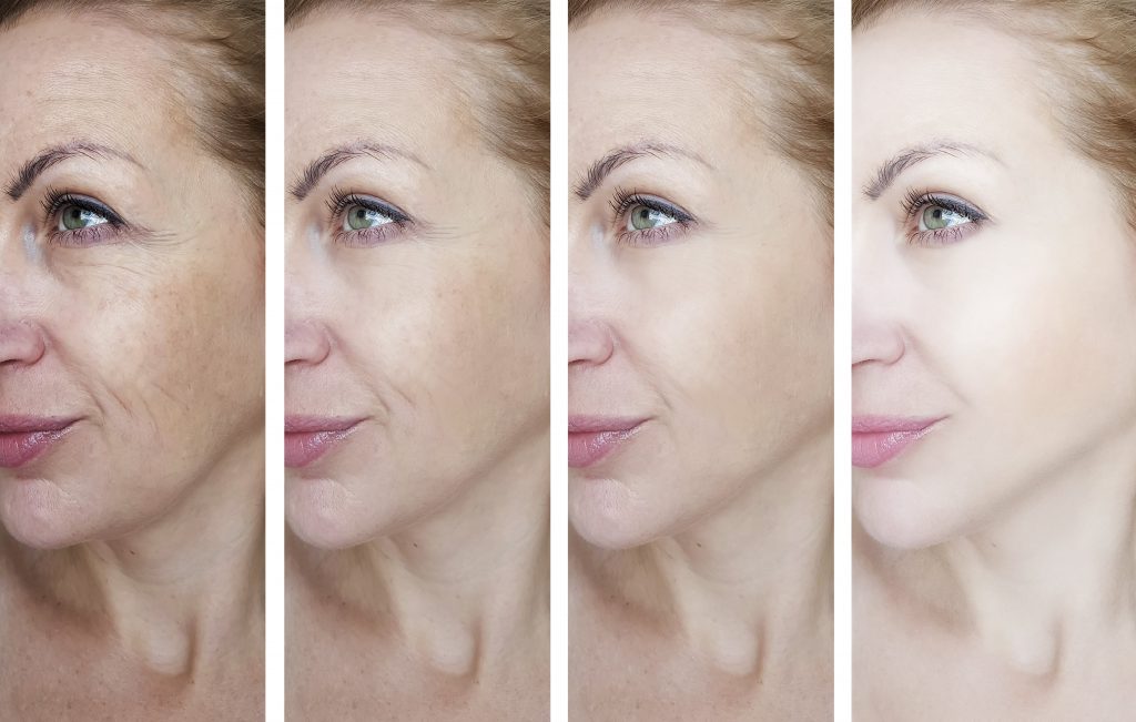 Skin Rejuvenation