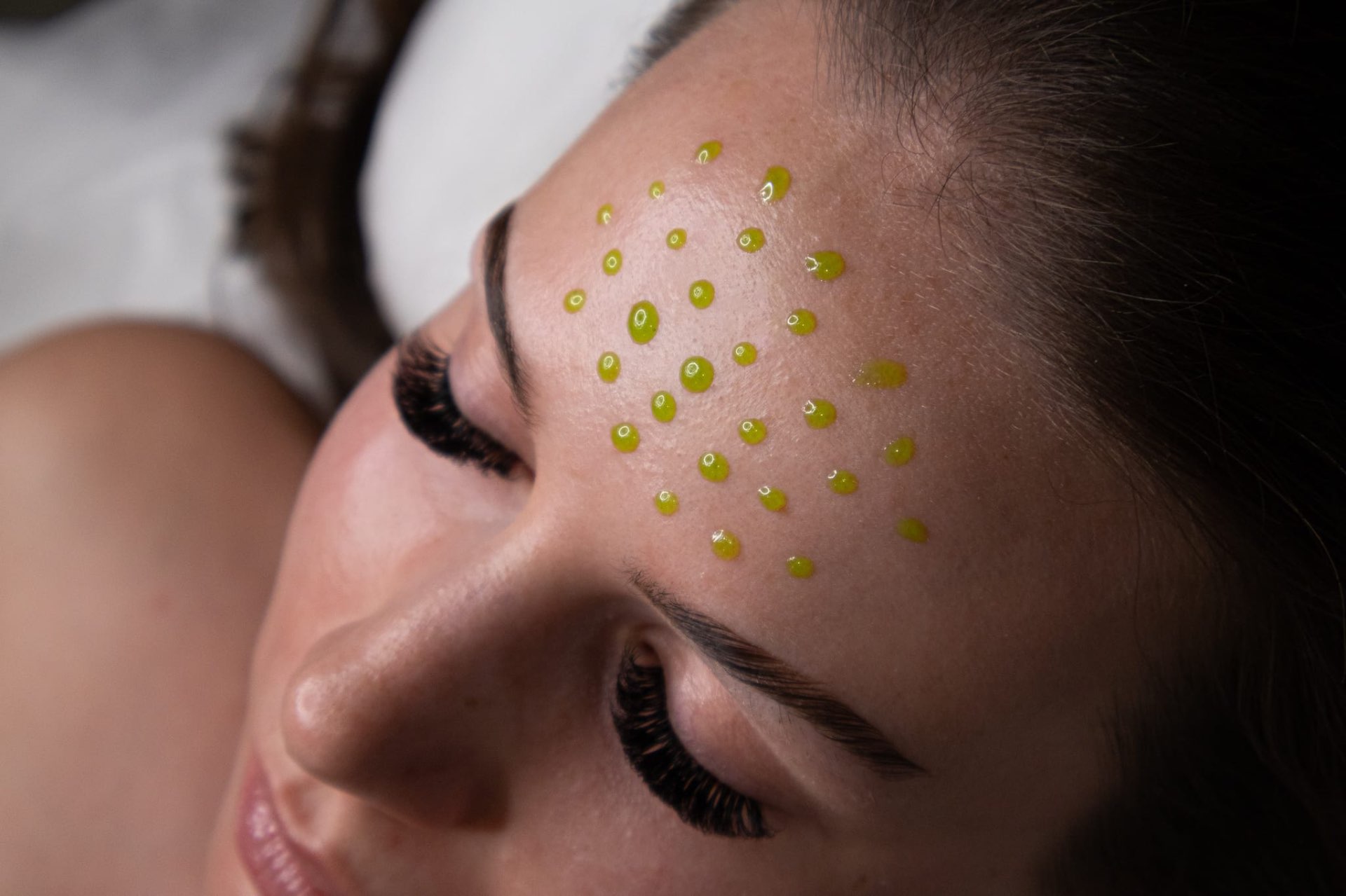 BioRePeel lipophilic phase applied to the forehead during treatment
