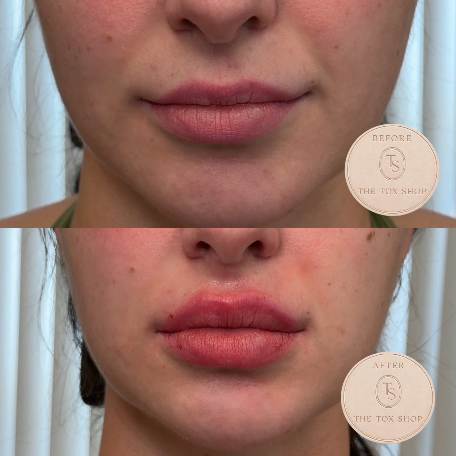 The Tox Shop lip filler before and after result
