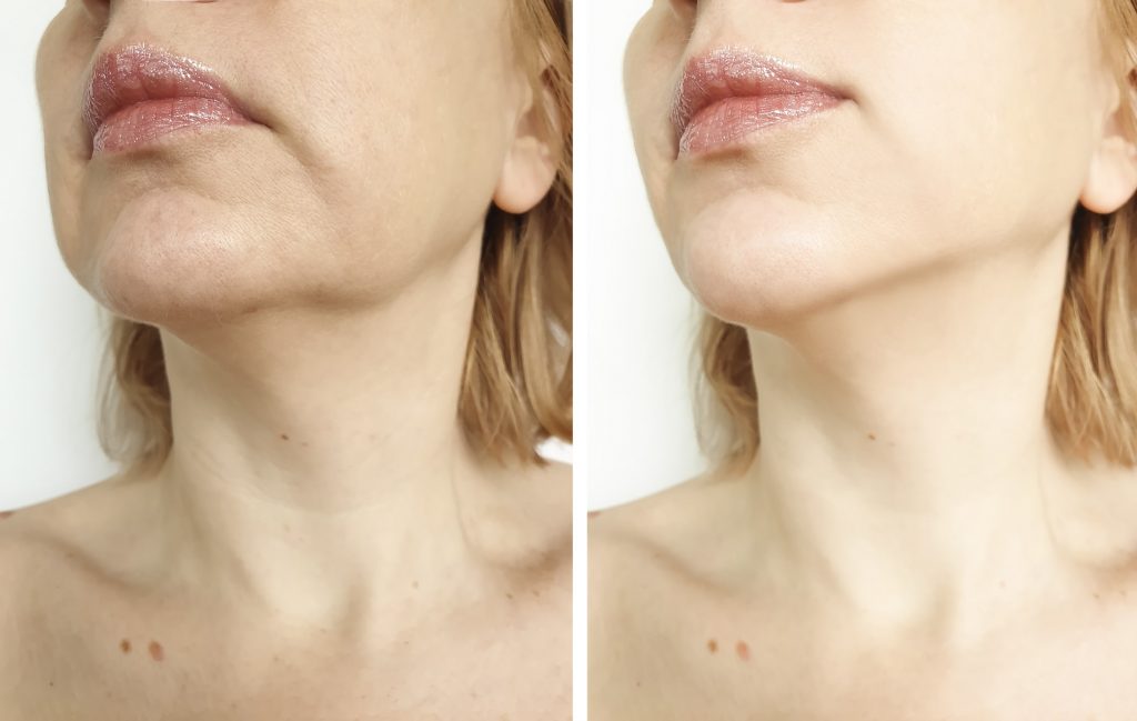 Skin Brightening