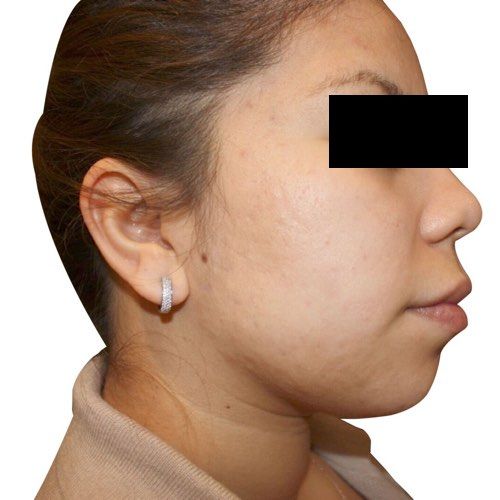 Active acne result — after