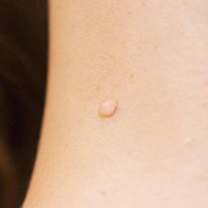 Skin Tag Removal