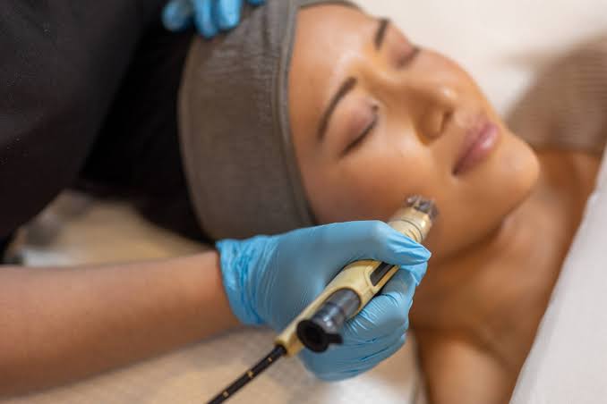 DermaFrac microneedling treatment in progress