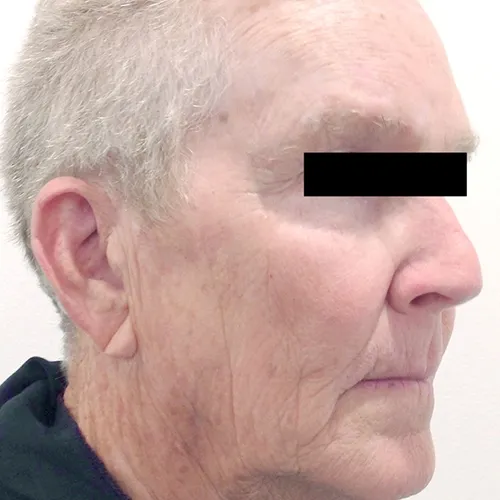 Age spots and texture result — after