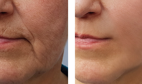 Wrinkle Removal