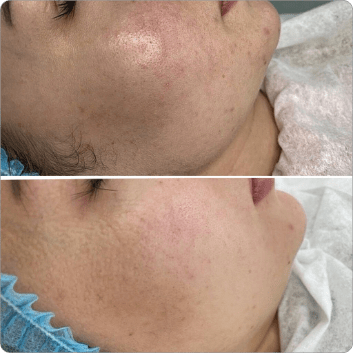 BioRePeel before and after result 1