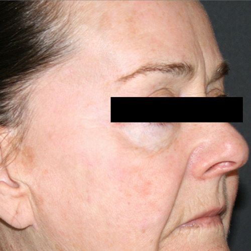 Skin rejuvenation result — after
