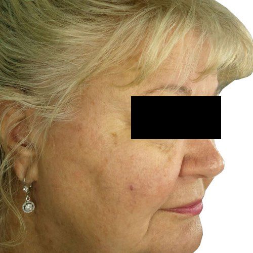 Sun damage and pigmentation result — after