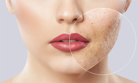Acne / Facial Scarring