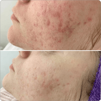 BioRePeel before and after result 3