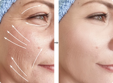 Skin Lifts