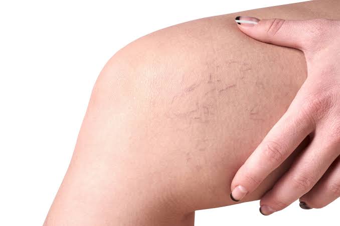 Spider Vein Removal