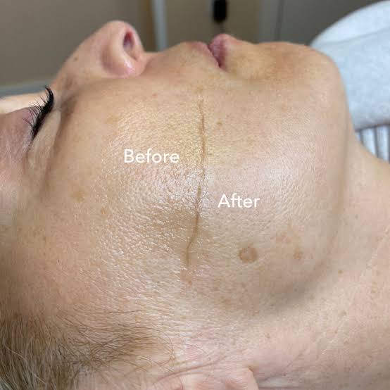 Before and after comparison during a dermaplaning treatment