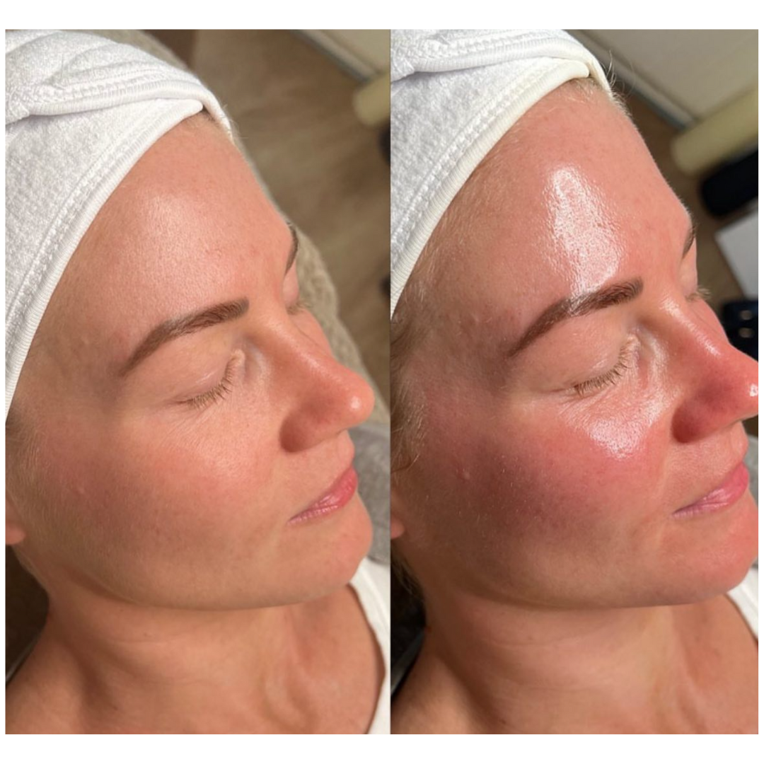 Before and after BioRePeel treatment showing glowing, refreshed skin