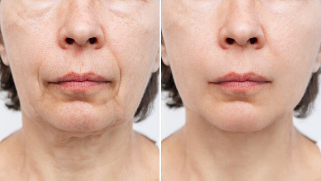 Wrinkle Removal