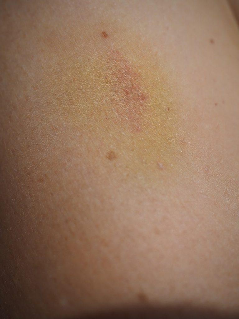 Skin Discoloration
