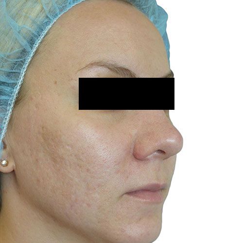 Acne scarring result — after