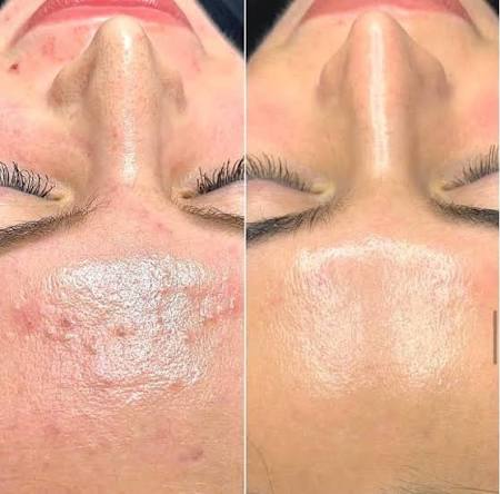 Before-and-after results after the hydrophilic phase of BioRePeel