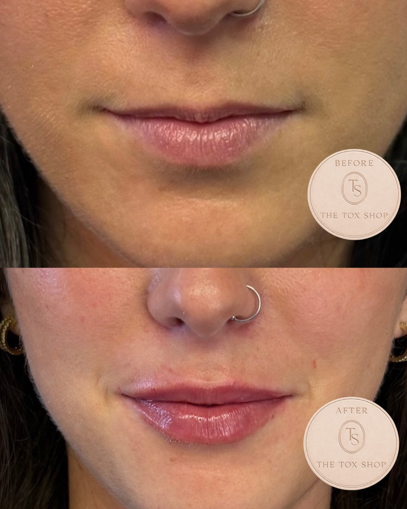 The Tox Shop lip enhancement before and after result